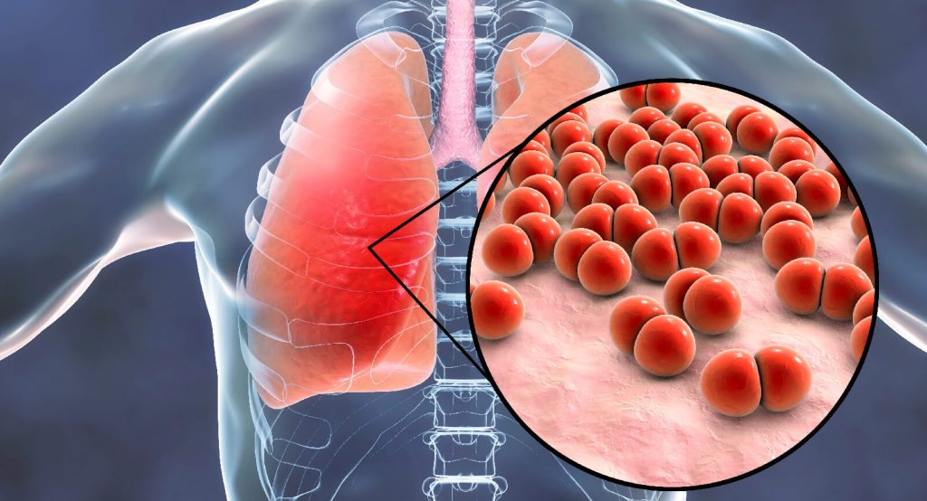 Course Image Ventilator-Associated Pneumonia (VAP) Prevention: A Comprehensive Guide for Nurses